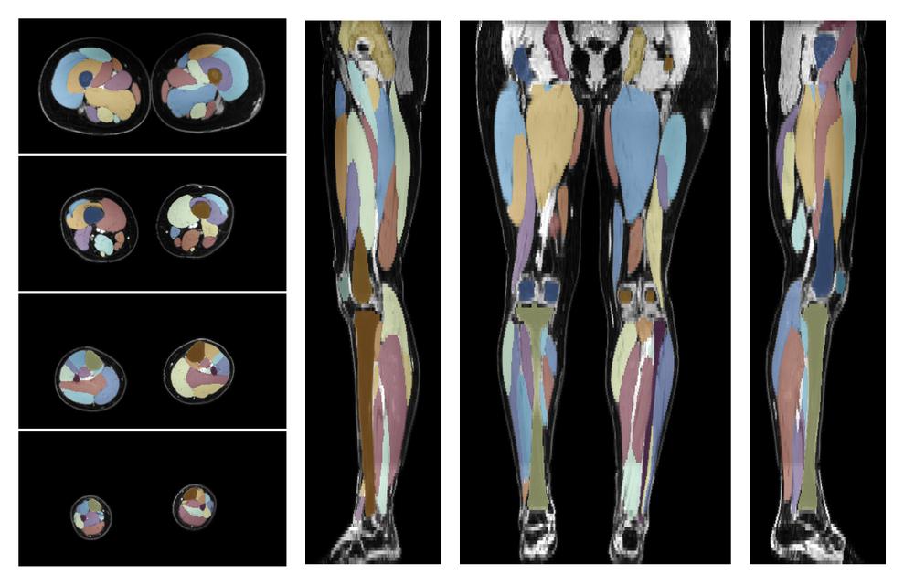 Overlay of automated muscle segmentation labels on dixon water image.